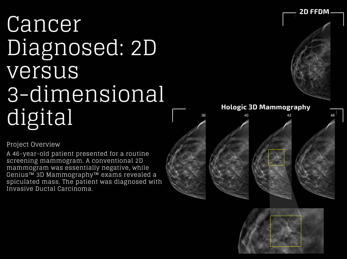 2D vs 3D mammography